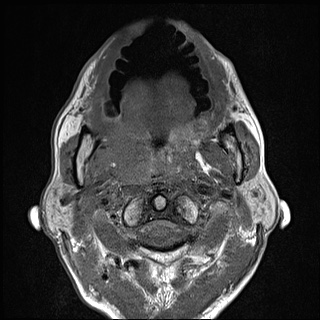 File:Nasopharyngeal carcinoma with skull base invasion (Radiopaedia 59258-66600 B 30).jpg