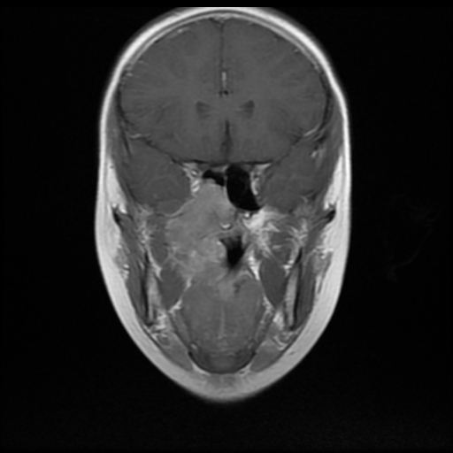File:Nasopharyngeal rhabdomyosarcoma (Radiopaedia 23417-23486 Coronal T1 C+ 7).jpg
