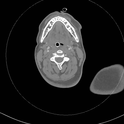 Neck CT angiogram (intraosseous vascular access) (Radiopaedia 55481-61945 B 200).jpg