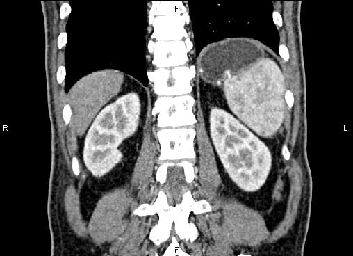 Necrotizing pancreatitis (Radiopaedia 87796-104248 F 54).jpg