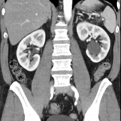 File:Necrotizing pancreatitis with acute necrotic collection (Radiopaedia 14470-14417 C 28).jpg