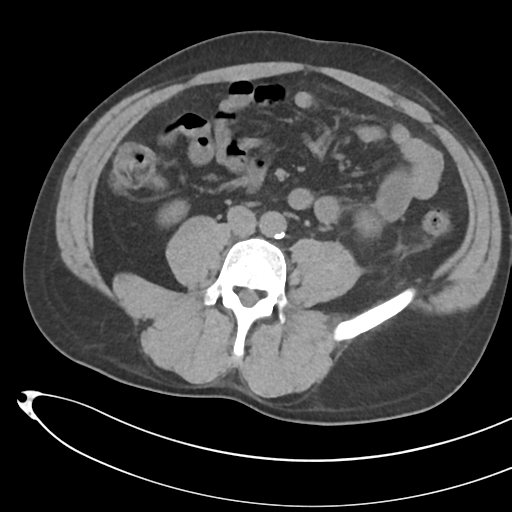 File:Necrotizing pancreatitis with acute necrotic collections (Radiopaedia 38829-41012 Axial non-contrast 49).png