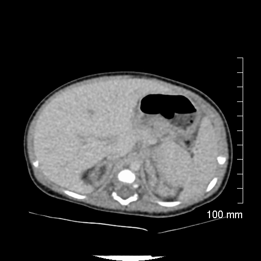 File:Neonatal neuroblastoma (Radiopaedia 56651-63438 Axial non-contrast 26).jpg