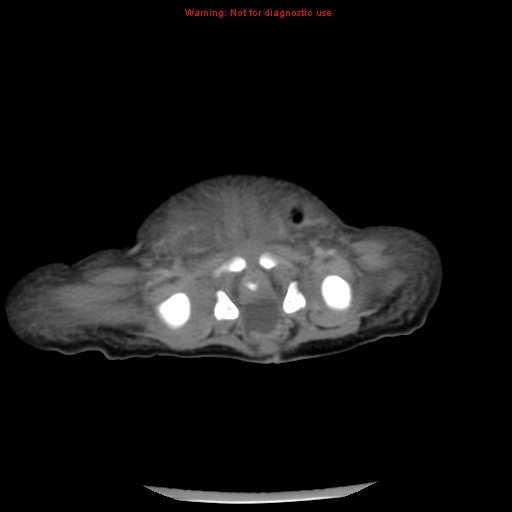 File:Neonatal neuroblastoma (Radiopaedia 9564-10223 A 44).jpg