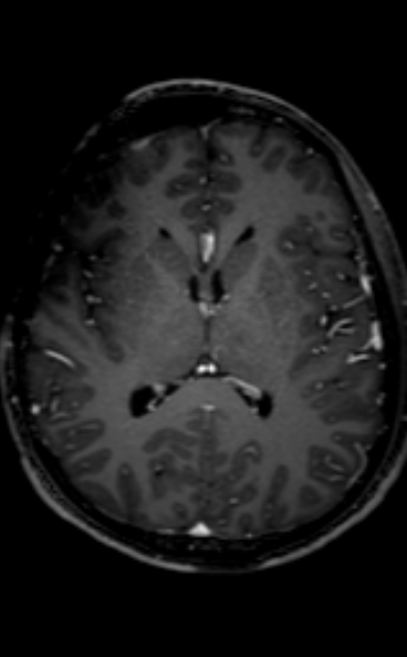Neuro-Behçet disease (Radiopaedia 90112-107294 Axial T1 C+ 123).jpg