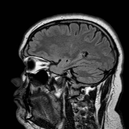File:Neuro-Behcet's disease (Radiopaedia 21557-21506 Sagittal FLAIR 24).jpg