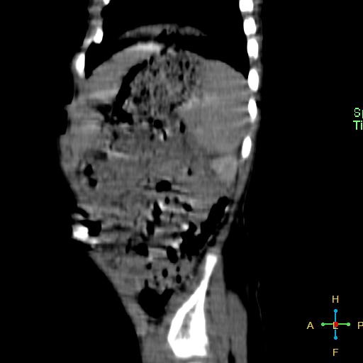 File:Neuroblastoma (Radiopaedia 24751-25016 C 4).jpg