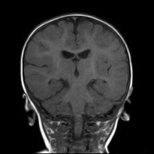 File:Neurofibromatosis type 1 (Radiopaedia 30089-30671 Coronal T1 17).jpg