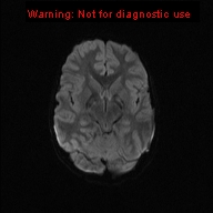 File:Neurofibromatosis type 1 with optic nerve glioma (Radiopaedia 16288-15965 Axial DWI 37).jpg