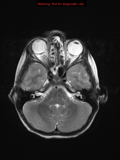 File:Neurofibromatosis type 1 with optic nerve glioma (Radiopaedia 16288-15965 Axial T2 19).jpg