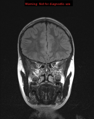 File:Neurofibromatosis type 1 with optic nerve glioma (Radiopaedia 16288-15965 Coronal FLAIR 19).jpg