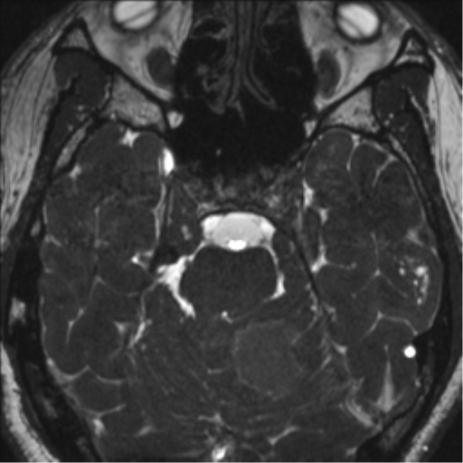 Neurofibromatosis type 2 (Radiopaedia 44936-48838 E 43).png
