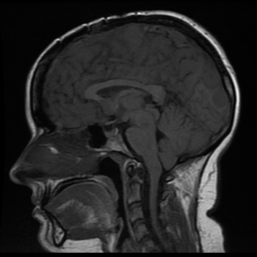 File:Neurofibromatosis type 2 (Radiopaedia 45229-49247 Sagittal T1 10).png