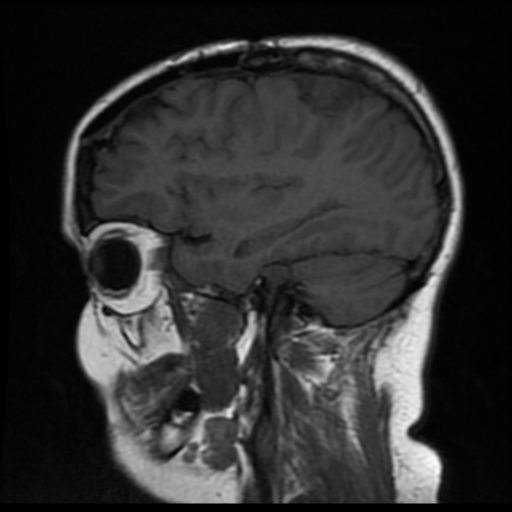 File:Neurofibromatosis type 2 (Radiopaedia 45229-49247 Sagittal T1 15).png