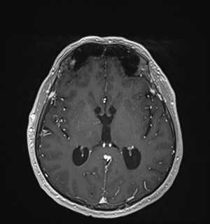 Neurofibromatosis type 2 (Radiopaedia 79097-92049 Axial T1 C+ 105).jpg