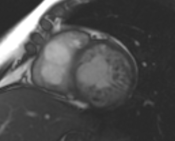 File:Non-compaction of the left ventricle (Radiopaedia 69436-79314 Short axis cine 140).jpg