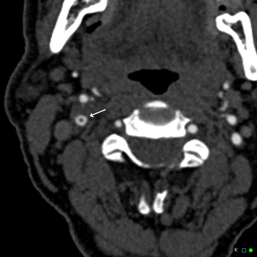 File:Non-occlusive intraluminal internal carotid artery thrombus (Radiopaedia 37751-39658 B 1).jpg