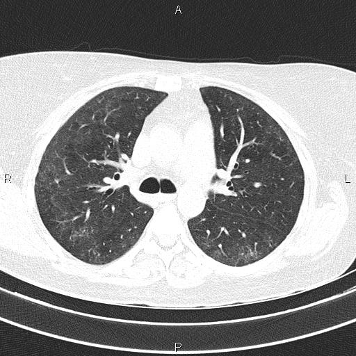 Non-specific interstitial pneumonia (Radiopaedia 83185-97567 Axial lung window 27).jpg