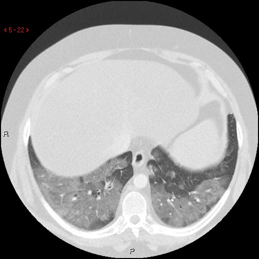 File:Non-specific interstitial pneumonitis (Radiopaedia 27044-27222 Axial lung window 13).jpg