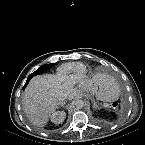 Non Hodgkin lymphoma in a patient with ankylosing spondylitis (Radiopaedia 84323-99621 Axial C+ delayed 12).jpg