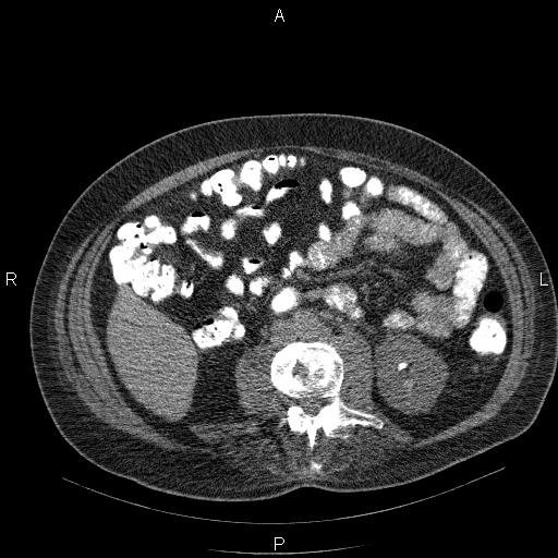 File:Non Hodgkin lymphoma in a patient with ankylosing spondylitis (Radiopaedia 84323-99624 Axial non-contrast 44).jpg