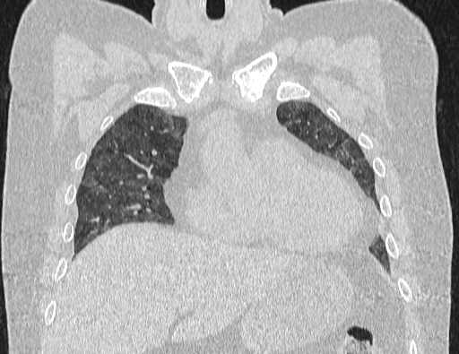 Non specific interstitial pneumonia (NSIP) (Radiopaedia 89725-106798 Coronal lung window 26).jpg