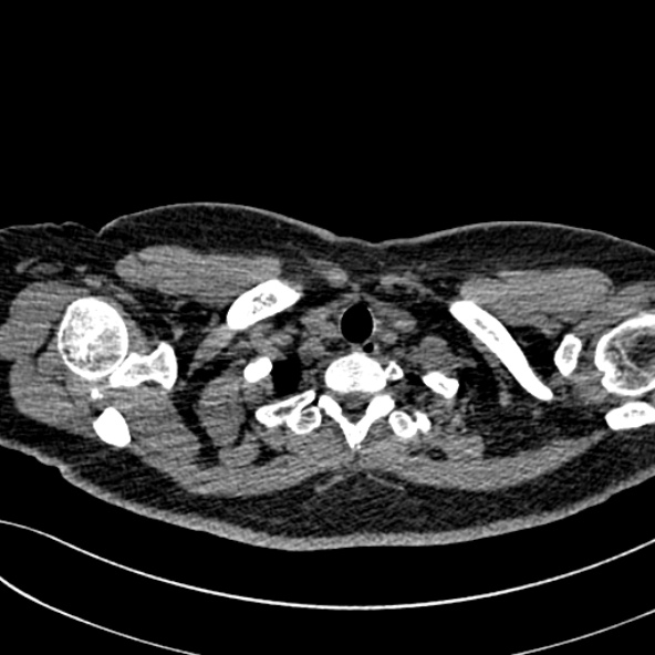 Normal CT chest- adult female (Radiopaedia 52522-58428 Axial non-contrast 12).jpg