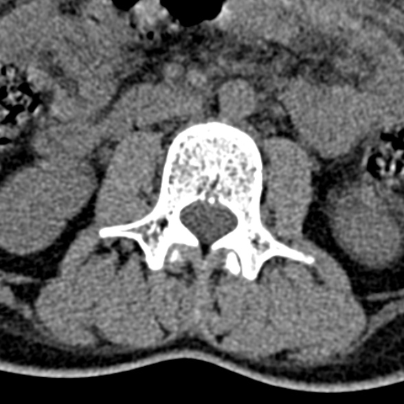 Normal CT lumbar spine (Radiopaedia 53981-60118 Axial non-contrast 46).jpg