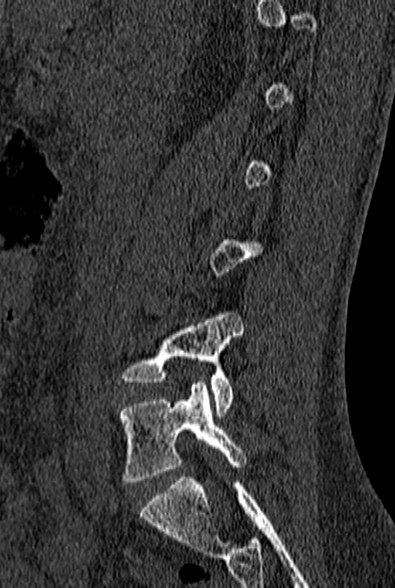 File:Normal CT lumbar spine (Radiopaedia 53981-60118 Sagittal bone window 29).jpg