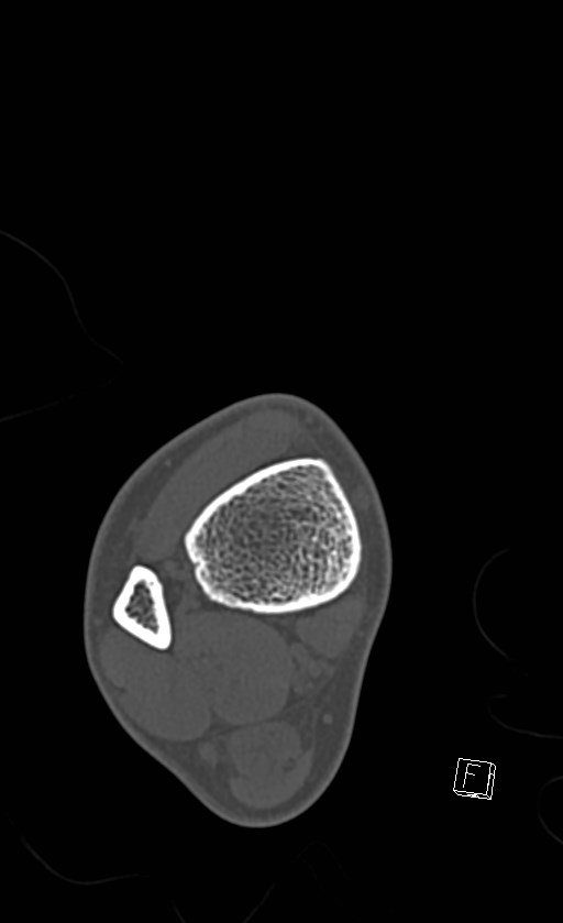 Normal CT of the ankle (Radiopaedia 47111-51658 Axial bone window 17).jpg