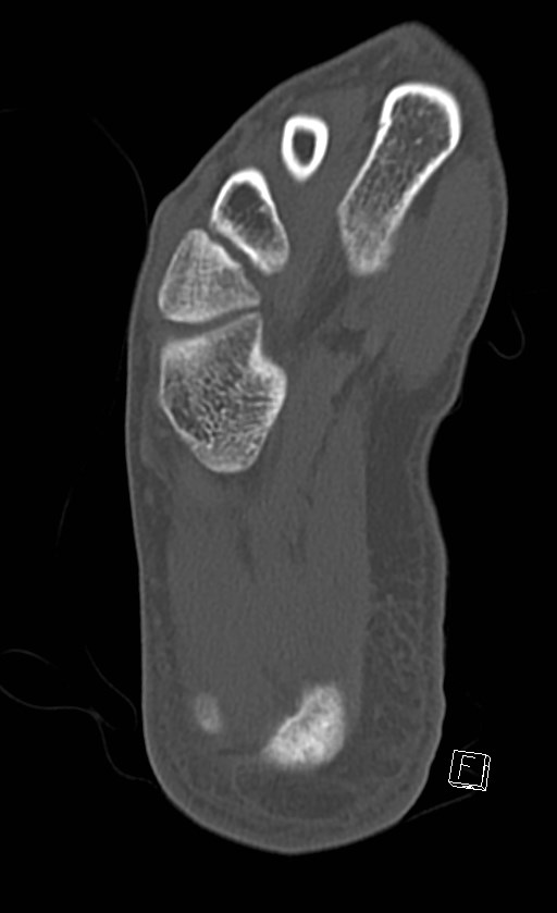 Normal CT of the ankle (Radiopaedia 47111-51658 Axial bone window 85).jpg