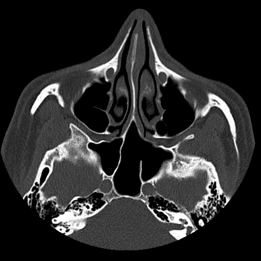 Normal CT paranasal sinuses (Radiopaedia 42286-45390 Axial bone window 63).jpg