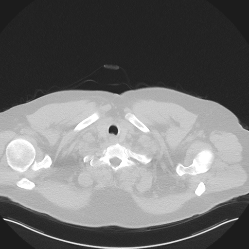 Normal HRCT (Radiopaedia 40797-43458 Axial lung window 2).png