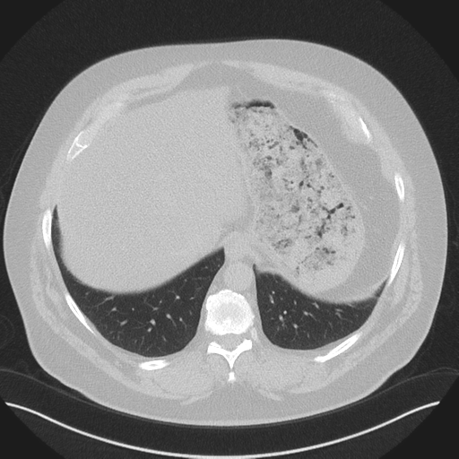 Normal HRCT (Radiopaedia 40797-43458 Axial lung window 49).png