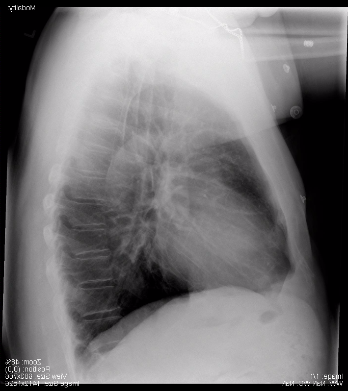 Normal Lateral Chest x-ray.png