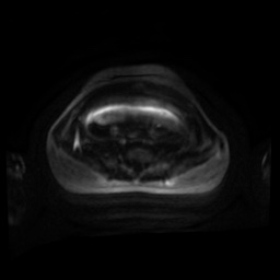 Normal MRI abdomen in pregnancy (Radiopaedia 88001-104541 Axial DWI 100).jpg