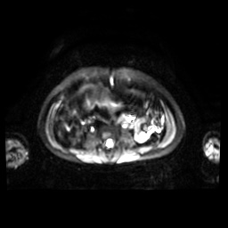 Normal MRI abdomen in pregnancy (Radiopaedia 88001-104541 Axial DWI 25).jpg