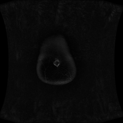 Normal MRI abdomen in pregnancy (Radiopaedia 88001-104541 M 12).jpg