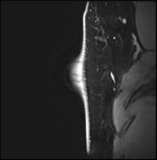 Normal breast MRI - dense breasts (Radiopaedia 80454-93850 I 39).jpg