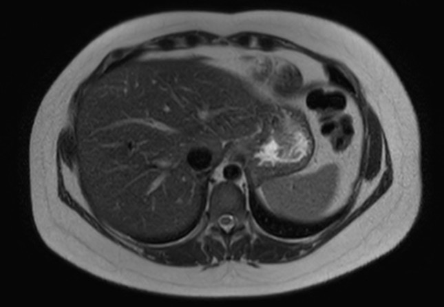 File:Normal liver MRI with Gadolinium (Radiopaedia 58913-66163 Axial T2 26).jpg