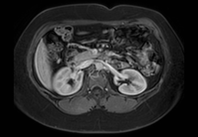 Normal liver MRI with Gadolinium (Radiopaedia 58913-66163 J 26).jpg