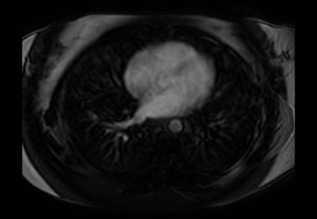 Normal liver MRI with Gadolinium (Radiopaedia 58913-66163 J 86).jpg
