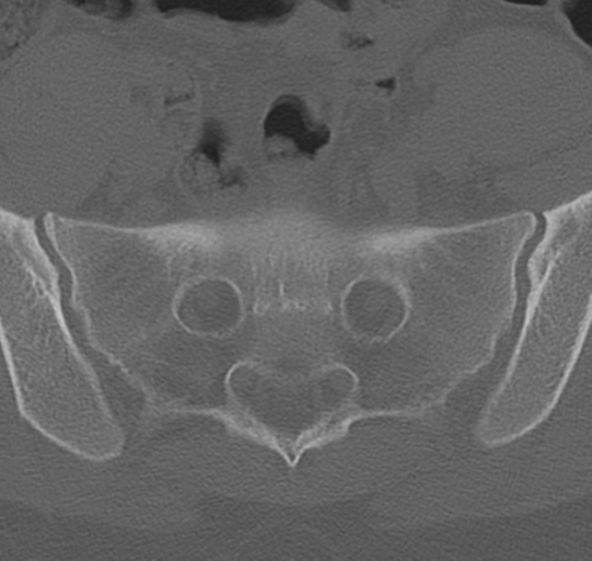 File:Normal lumbar spine CT (Radiopaedia 46533-50986 Axial bone window 73).png
