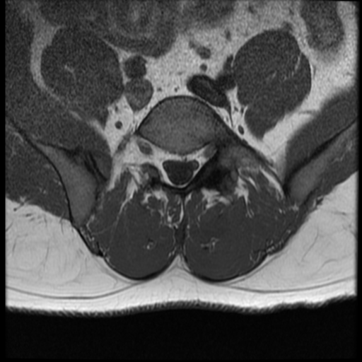File:Normal lumbar spine MRI (Radiopaedia 35543-37039 Axial T1 9).png