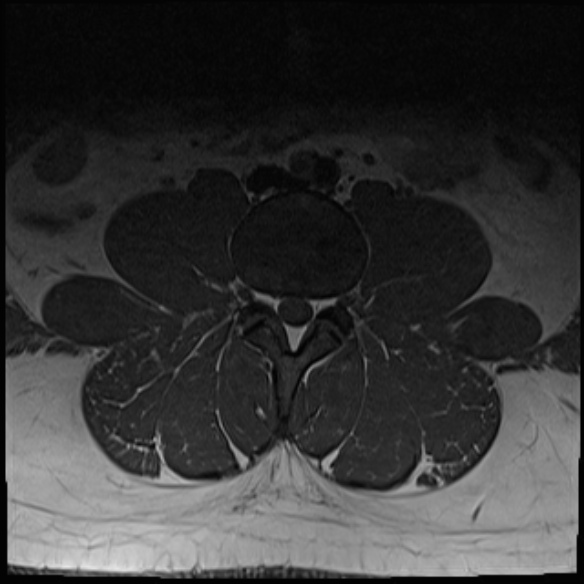 File:Normal lumbar spine MRI (Radiopaedia 47857-52609 Axial T1 8).jpg