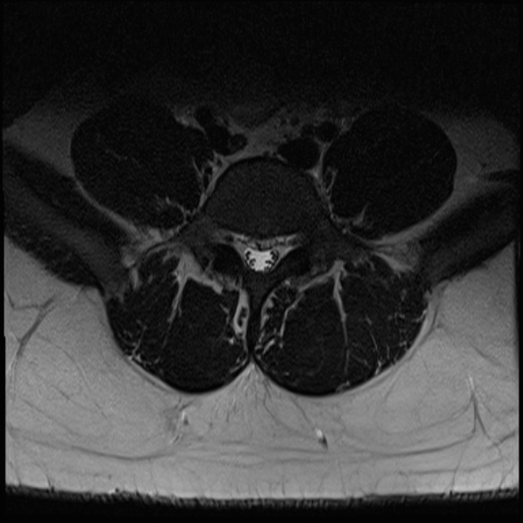 File:Normal lumbar spine MRI (Radiopaedia 47857-52609 Axial T2 23).jpg
