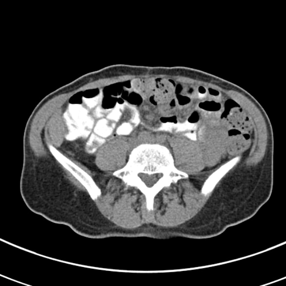 File:Normal multiphase CT liver (Radiopaedia 38026-39996 Axial non-contrast 54).jpg