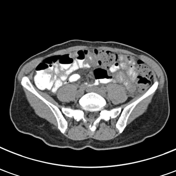 File:Normal multiphase CT liver (Radiopaedia 38026-39996 Axial non-contrast 59).jpg