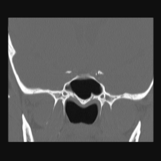 Normal sinus CT (annotated) (Radiopaedia 78917-91810 Coronal bone window 45).jpg