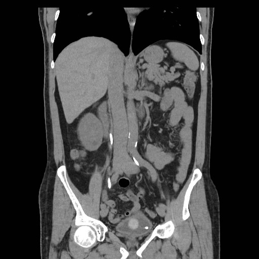 File:Obstructed kidney with perinephric urinoma (Radiopaedia 26889-27067 Coronal non-contrast 6).jpg